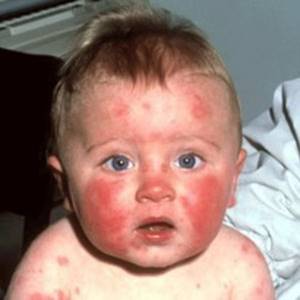 Аллергия на творог агуша у ребенка