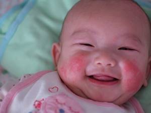 Аллергия у новорожденного на лице