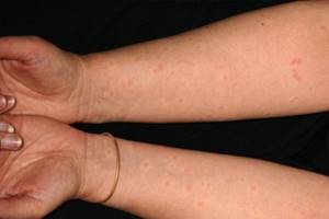 Аллергия на цитрусовые