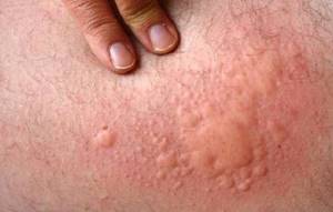 признаки аллергии на коже