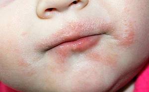 Аллергия на сладкое на лице