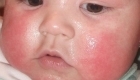 Что дать новорожденному от аллергии