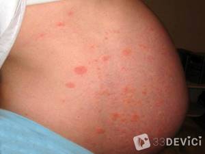 От аллергии для беременных