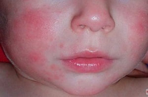 Что делать если у новорожденного аллергия