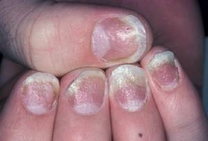 После наращивания ногтей чешутся пальцы