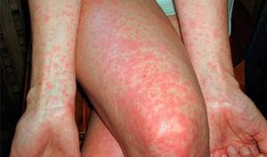 Аллергия на укусы насекомых лечение