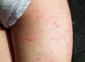 Аллергия на моющие средства