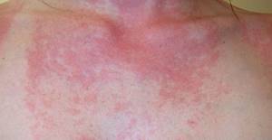 Солнечная аллергия симптомы и лечение