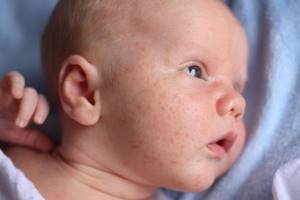 У новорожденного аллергия на лице что делать