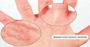 Чем лечить контактный дерматит