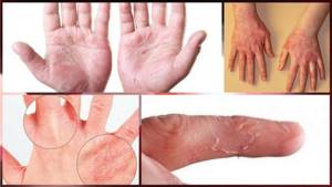 Аллергический дерматит на пальцах рук