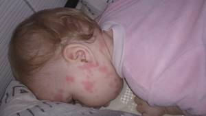 Сироп от аллергии для детей