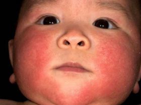 Аллергическое покраснение кожи