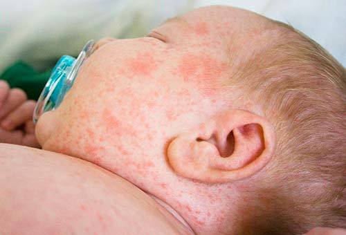 Аллергия на череду у новорожденного