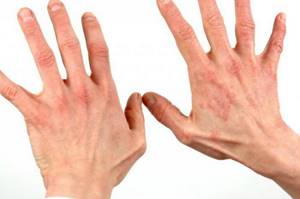 Таблетки от дерматита на руках