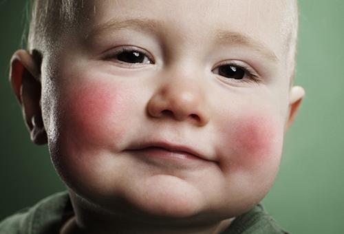 Аллергия на овсяную кашу у ребенка