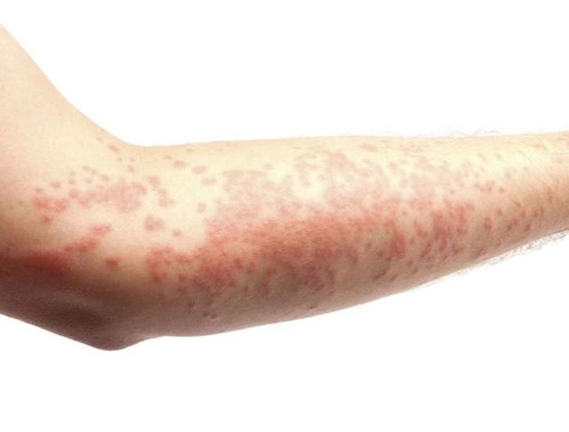 Аллергия на пальцах рук