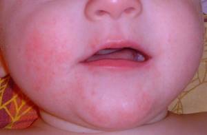 Аллергия на эспумизан