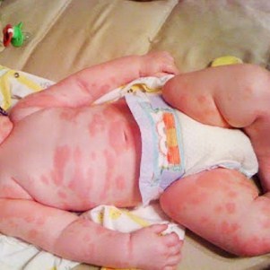 Сыпь после антибиотиков у ребенка
