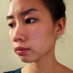 Сильная аллергия на лице
