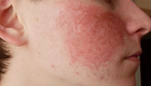 Аллергия на крем для лица что делать