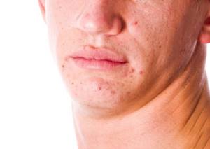 Высыпания на щеках у взрослого причины
