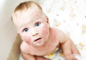 Как выглядит аллергическая сыпь у детей