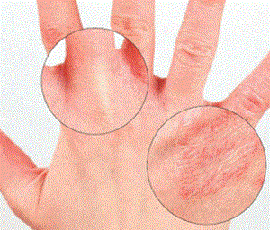 Как лечить экзему на пальцах рук