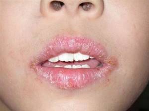 Аллергия на губах симптомы
