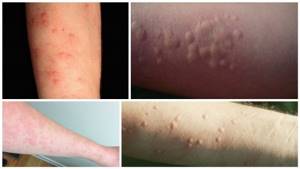 Диета при аллергии на коже у взрослых