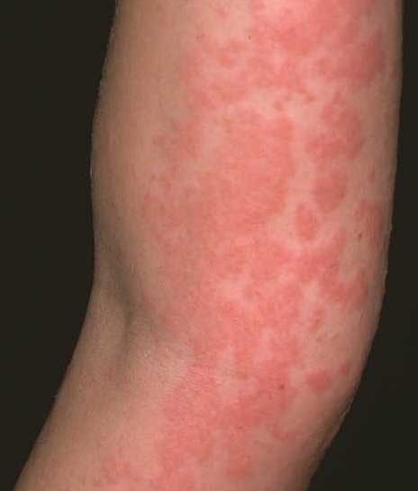 Аллергия от нервов симптомы