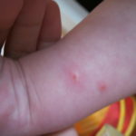 Аллергия у ребенка на комариные укусы