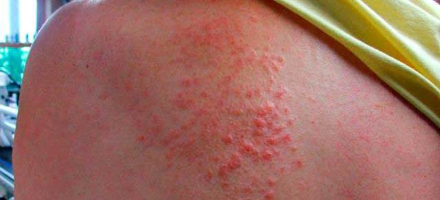 Аллергия на фреон