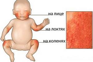 Лечение атопического дерматита у детей народными средствами