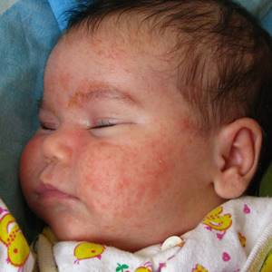 Аллергия на грушу у ребенка