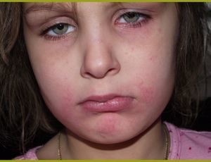 Аллергия на арахис симптомы