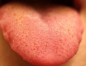 Аллергия на языке у ребенка