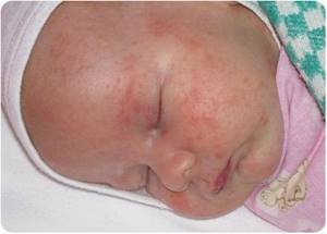 Аллергия на малютку