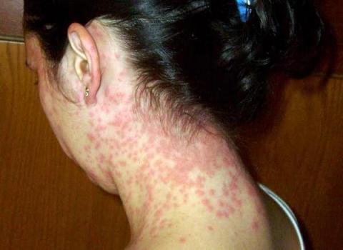 Лекарства при аллергии на коже