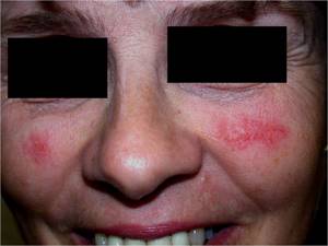 Сильная аллергия на лице