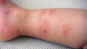 Аллергия на укусы клопов