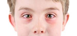 Аллергия на мяту у детей