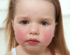 Пищевая аллергия у ребенка лечение