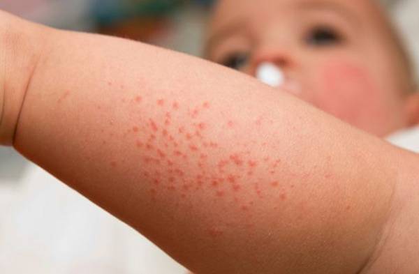 Температура при аллергии у ребенка