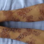 Аллергия после татуировки