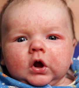 Аллергия на каши у ребенка