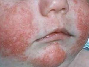 Аллергический дерматит лечение у взрослых