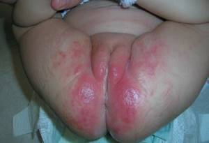 Пеленочный дерматит лечение комаровский