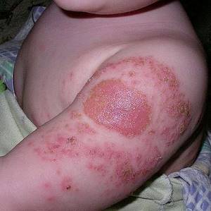 Манту при аллергии у ребенка