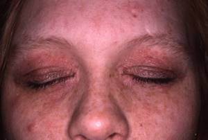 Пятна на теле аллергия